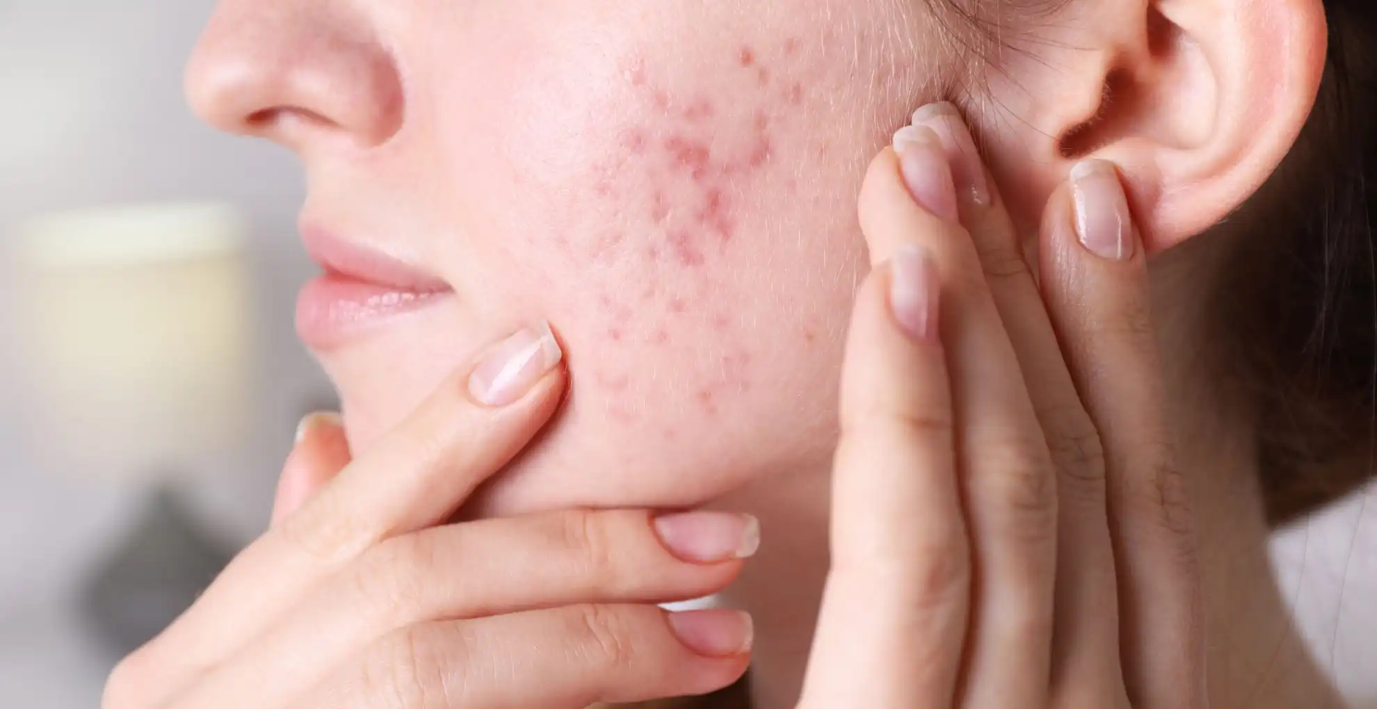 Saw Palmetto's Acne-Fighting Properties
